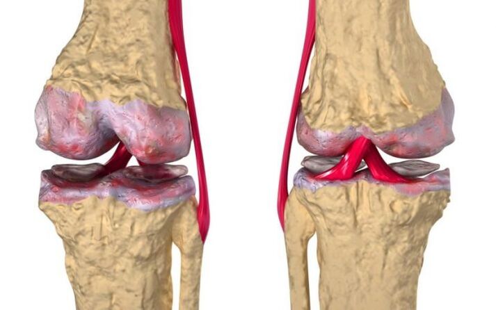 Ceļa locītavas osteoartrīts